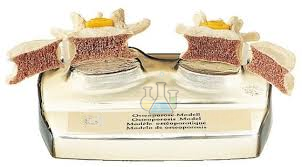 Osteoporosis Model
